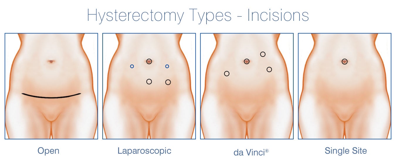 Intercourse After Laparoscopic Surgery 19