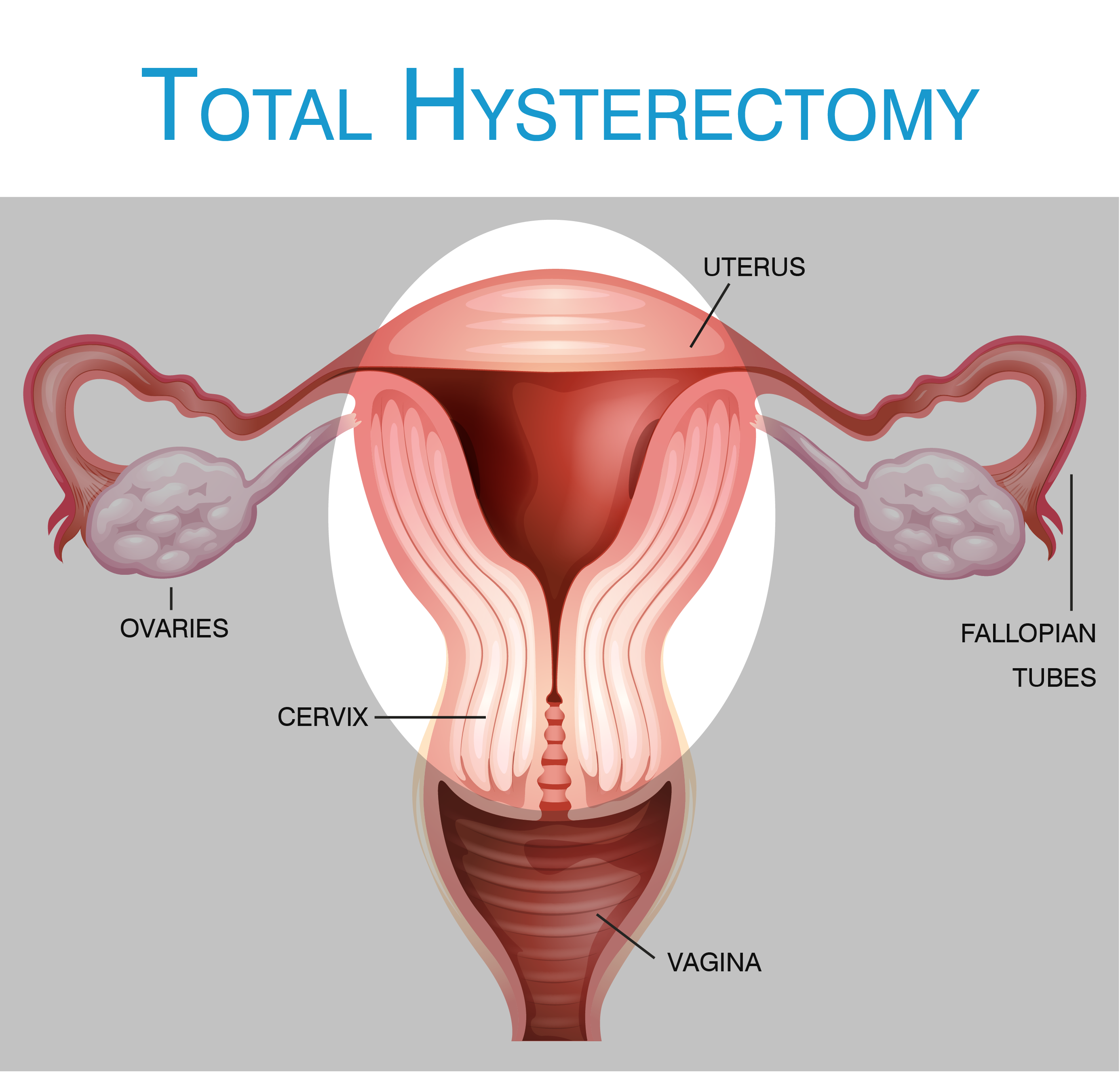 What Is A Hysterectomy 