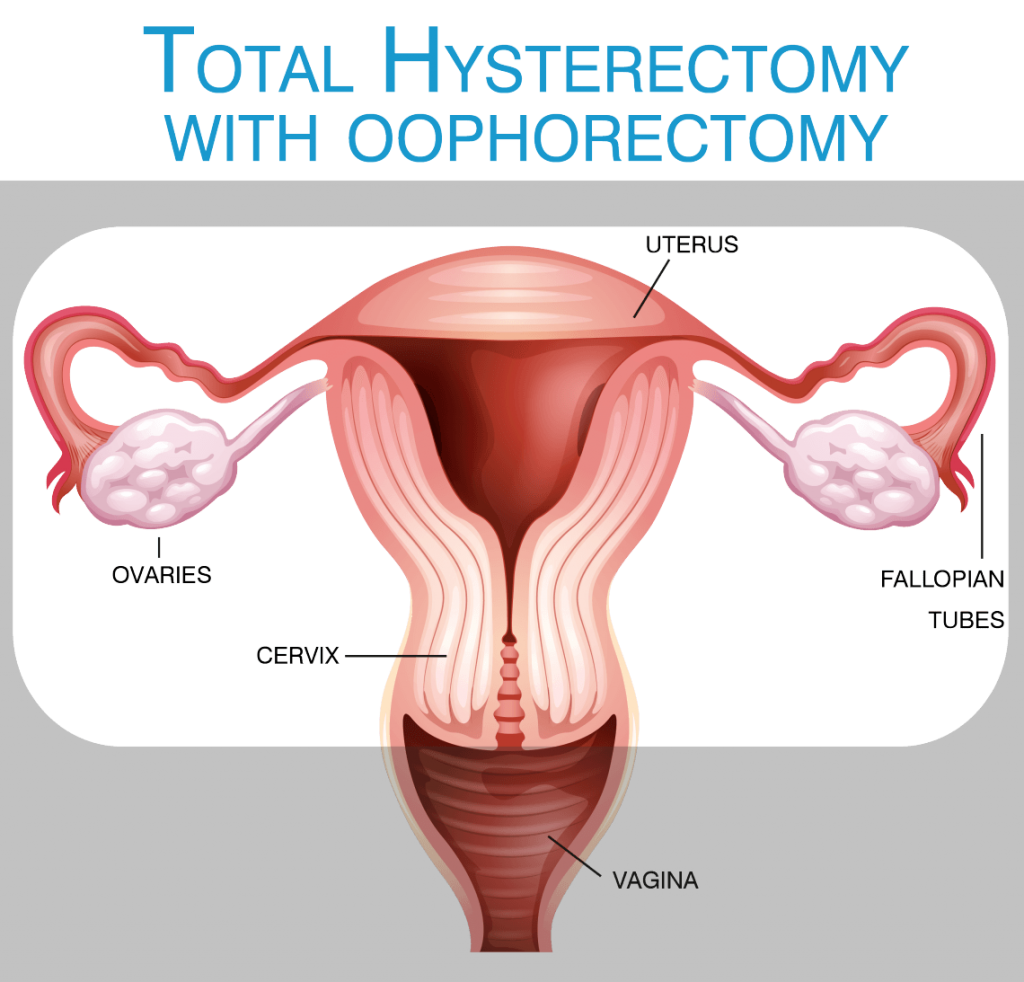 Pros Cons Leaving Ovaries After Hysterectomy