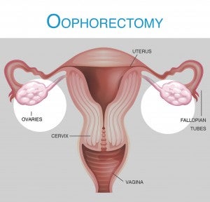 oophorectomy diagram