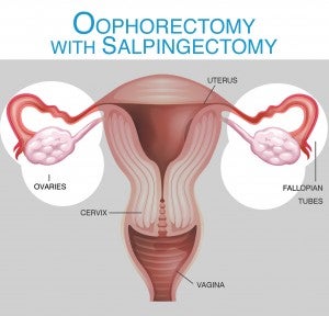 oophorectomy-salpingectomy