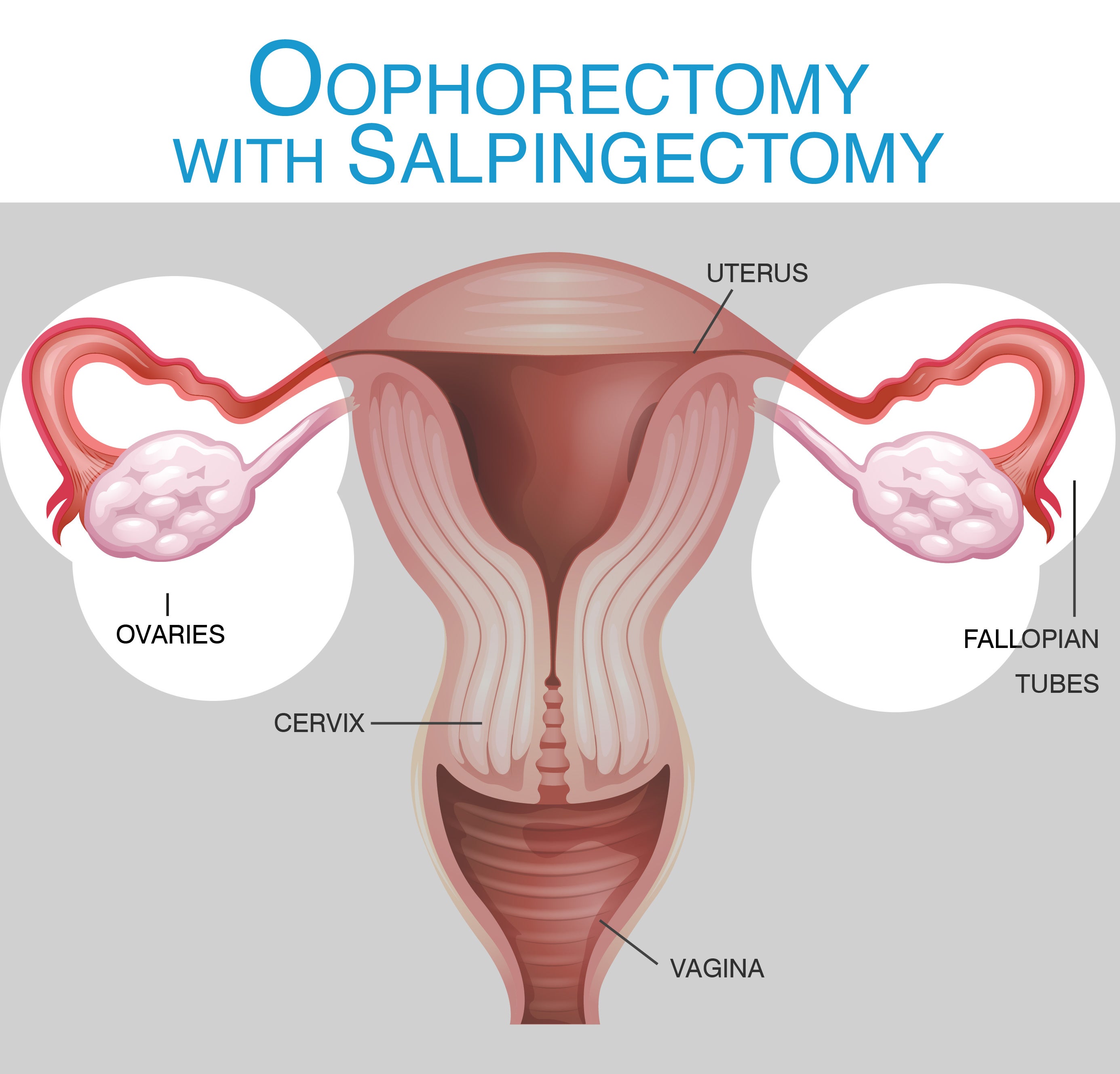 Oophorectomy Stock Vector Images - Alamy