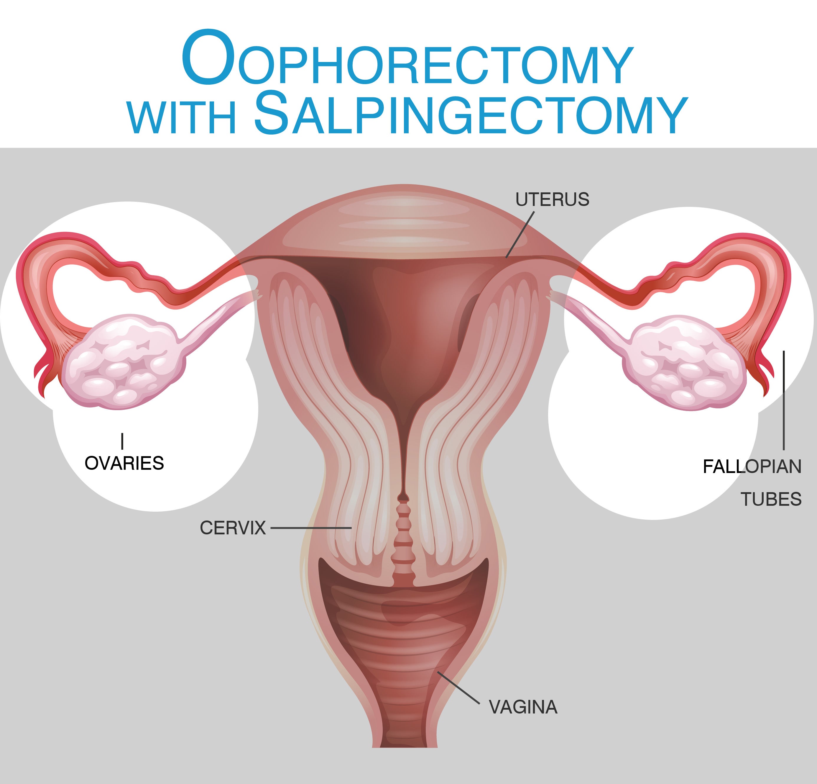 Ooforectomia bilateral.  Download Scientific Diagram